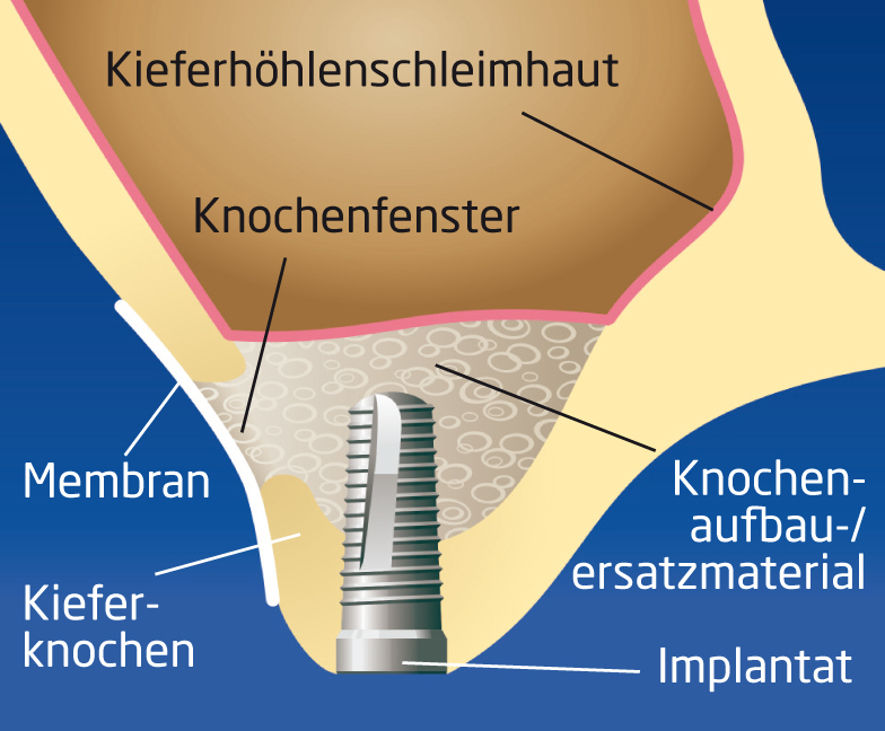 Zahnimplantate Kohlberg